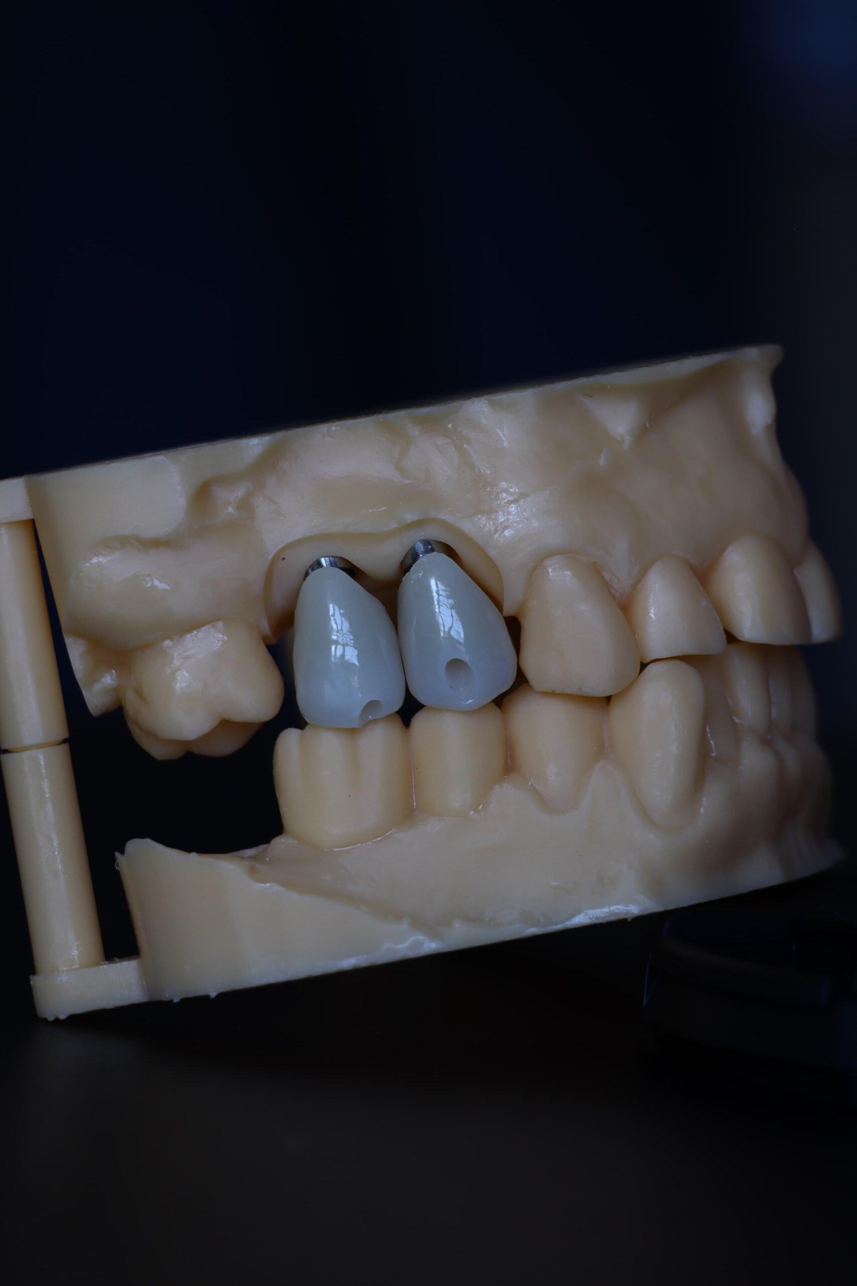 Corone in zirconia avvitate su impianti, vista laterale sul modello