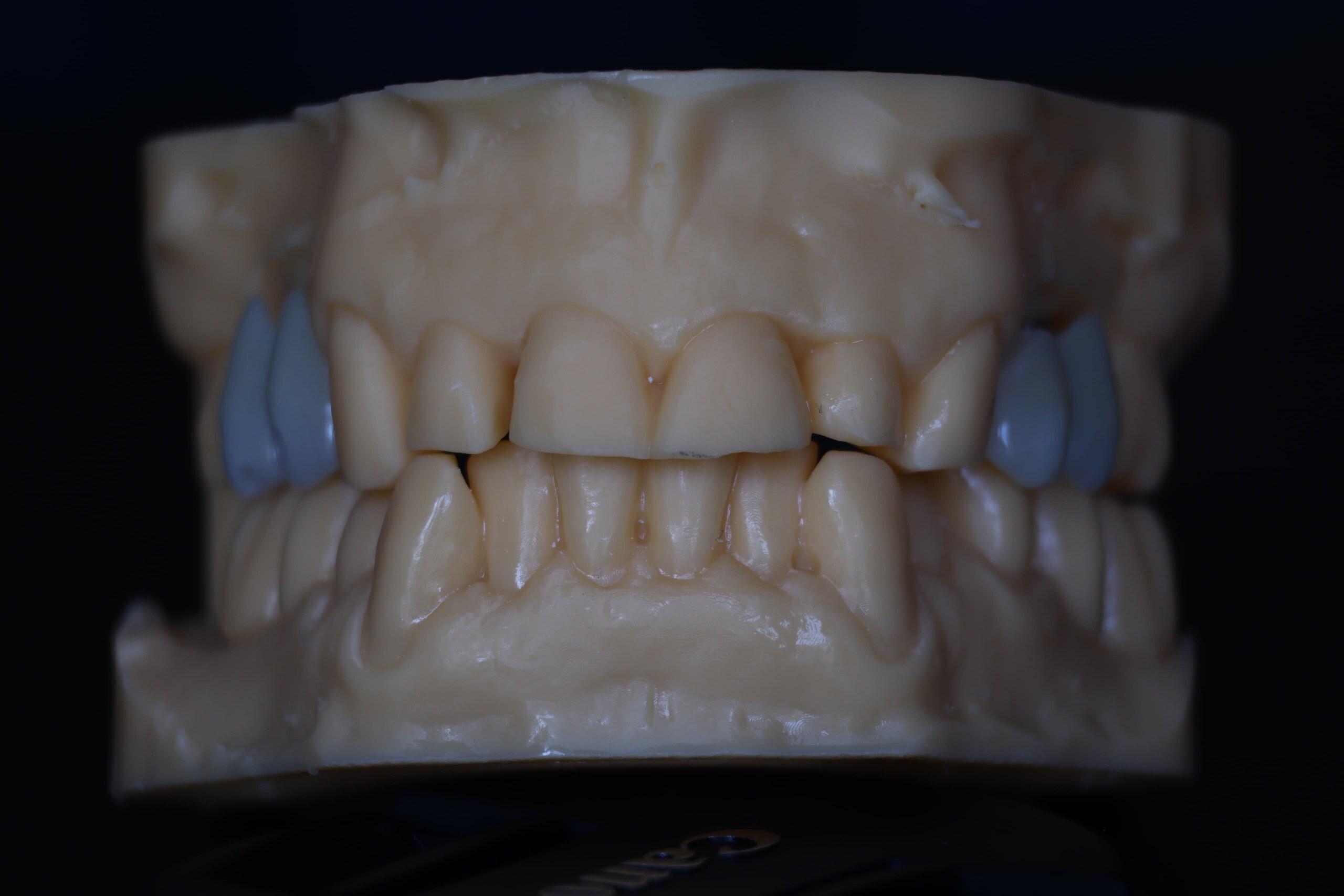 Corone zirconio avvitate su impianto, vista frontale sul modello