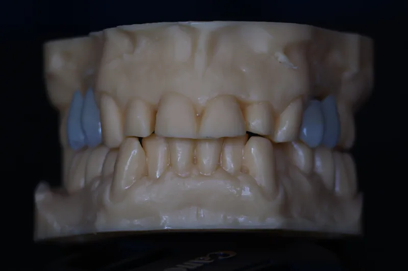 Corone zirconio avvitate su impianto