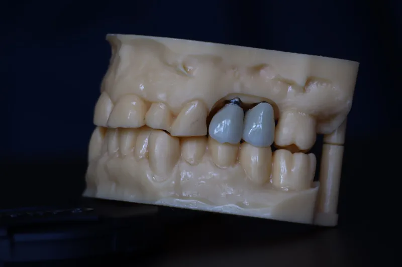 Corone zirconio avvitate su impianto