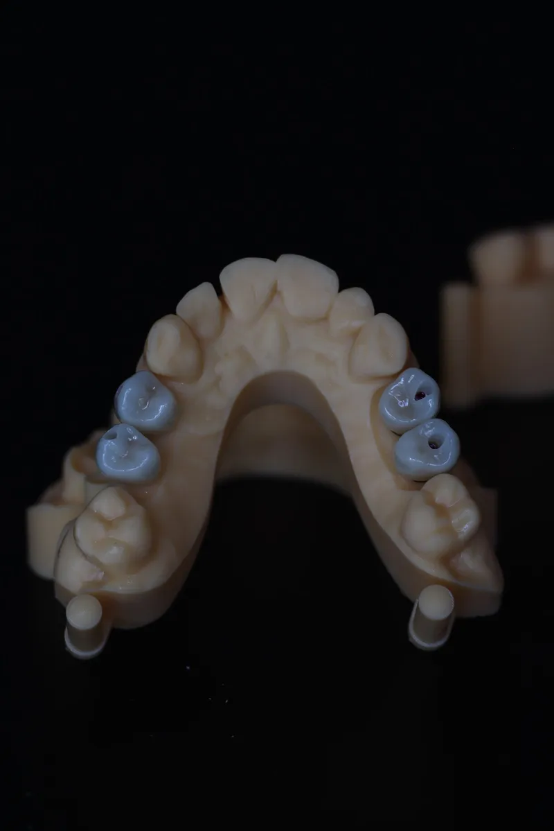 Corone zirconio avvitate su impianto