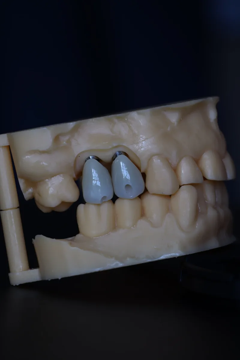 Corone zirconio avvitate su impianto